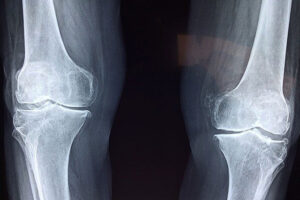 Arthritis Treatment