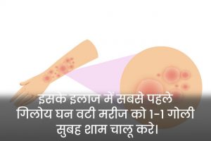 Fungal-Infection
