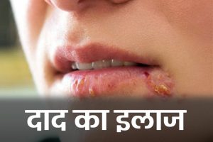 Treatment-of-herpes