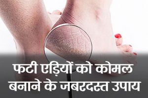 Cracked-heels-treatment