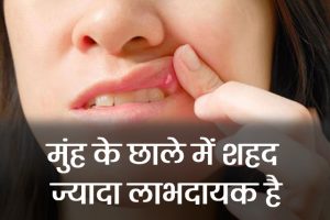Mouth-ulcer-Remedies